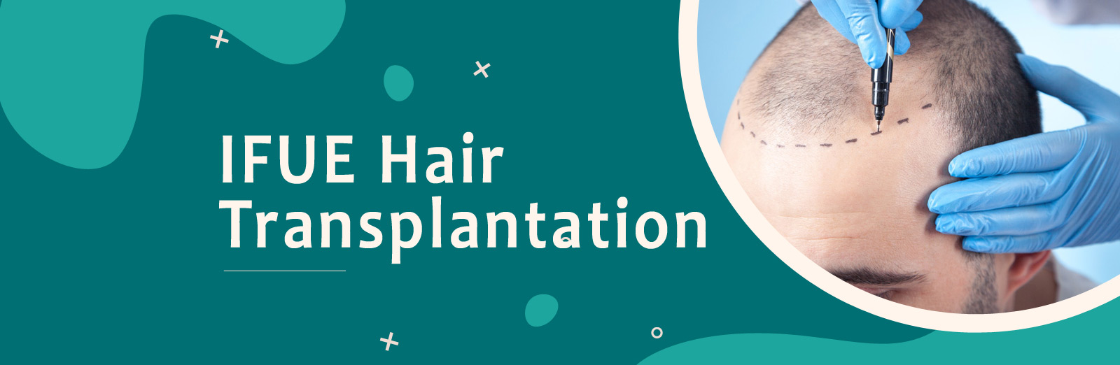 iFUE Hair Transplantation