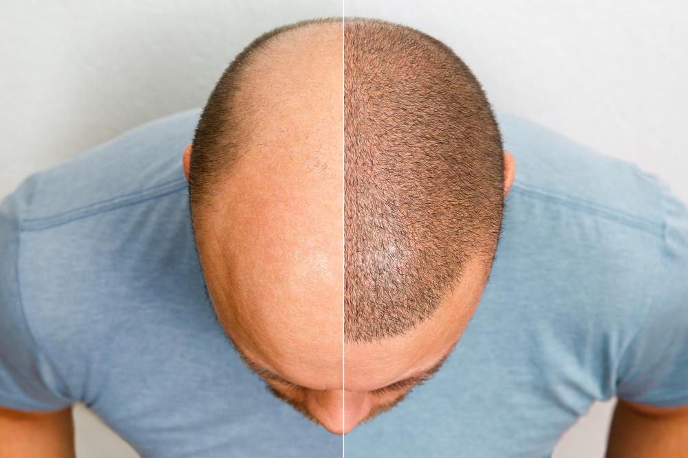 iFUE Hair Transplantation