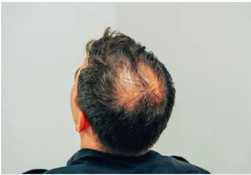 Best Hair Transplant in Hyderabad, Skin Care Clinics in Hyderabad Best Hair Transplant in Hyderabad, Skin Care Clinics in Hyderabad