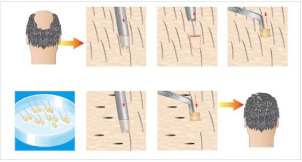iFUE Hair Transplantation - Scala Clinic iFUE Hair Transplantation - Scala Clinic