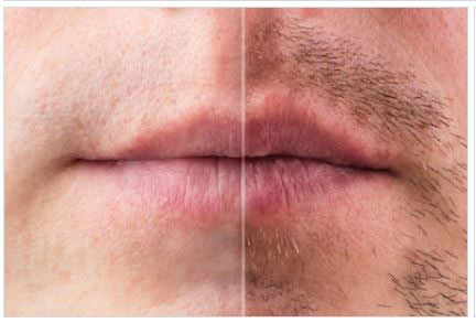 MUSTACHE HAIR LOSS 